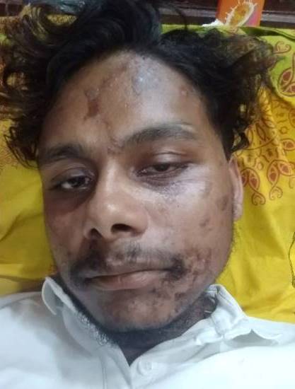 ५ लाख खर्चेर दुबई पुगेका सन्तोष : काम माग्दा यातना, तातो दाल मुखमा झोसियो